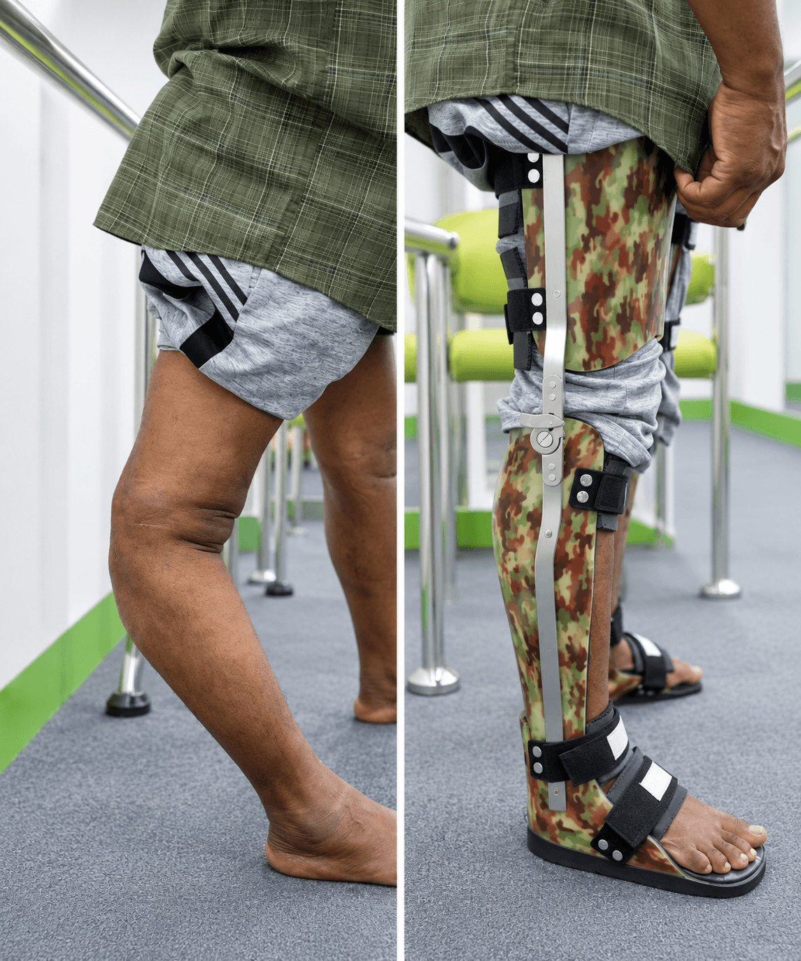 Leg and foot orthosis at Cornerstone P&O
